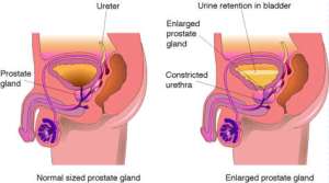 prostate-bph